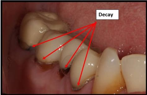 Tooth decay - Album View Page - Wolmal