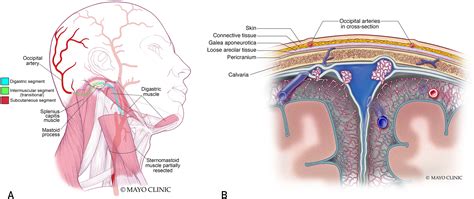 Temporal Artery Biopsy Anatomy Intraoperative Image Of A Temporal