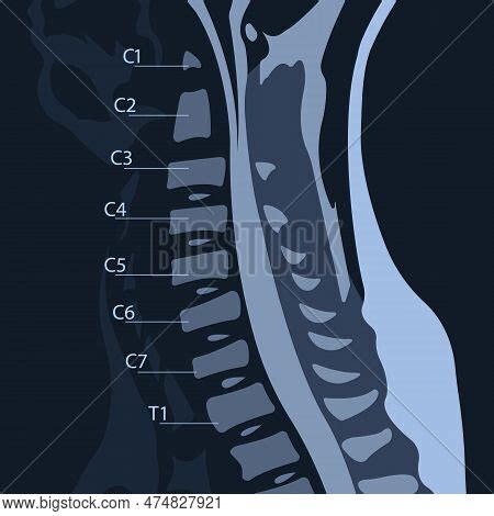 Spinal Cord Compression 的图像结果
