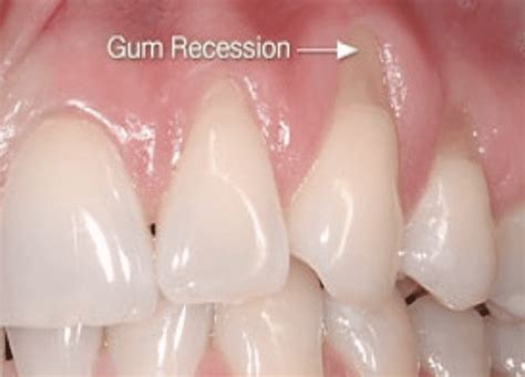 Tooth Recession 的图像结果