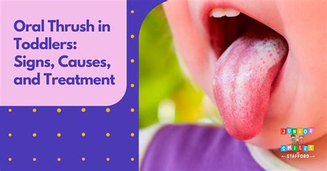 Is Oral Thrush In Adults Contagious By Kissing at Laura Timbery blog
