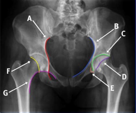 Pelvis Anatomy Xray