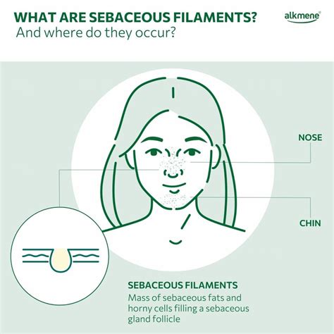 Sebaceous Filaments Wirkung , Sebaceous Filaments: Gejala, Penyebab dan ...