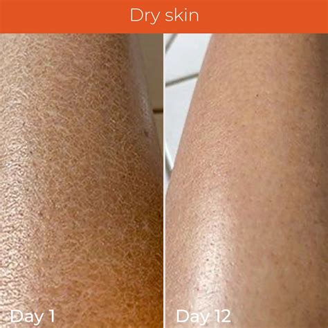 SPF 40 PA ++++ Mist for De-tan, Hydration, and Protection – Skinvest