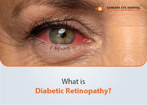 Diabetic Eye Problems 的图像结果