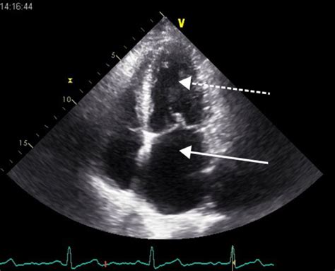 How big a problem is heart failure with a normal ejection fraction ...