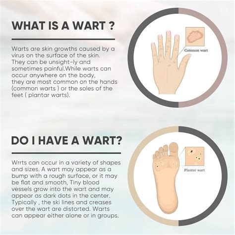 What Is The Difference Between Corn Remover And Wart Remover at Kevin ...