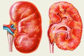 Antimicrobials for acute Pyelonephritis : 2018 NICE guidelines