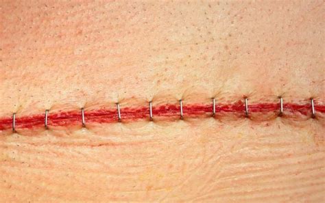 辟谣丨手术以后，伤口缝线都是一周拆线？医生：并不是 - 简书