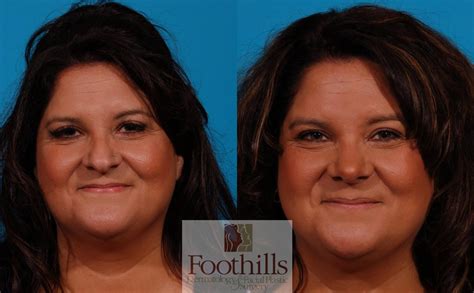 Rhinoplasty Before & After Photos Patient 157 | Tucson, AZ | Foothills Facial Plastic Surgery