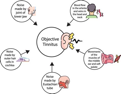 Tinnitus Definition at Donald Altman blog