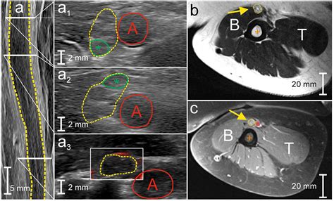 Peripheral Nerve Imaging Aids in the Diagnosis of Immune-Mediated ...