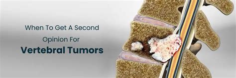 Get a Second Opinion for Vertebral Tumours Care