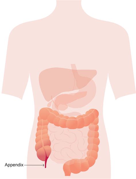 Appendix operation | Appendix Treatment in Surat | Excel Laparoscopy