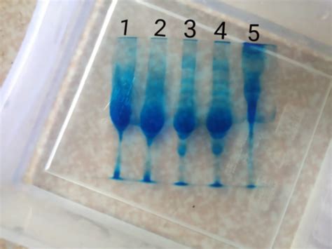 Evaluation of serum protein electrophoresis in patients with renal ...