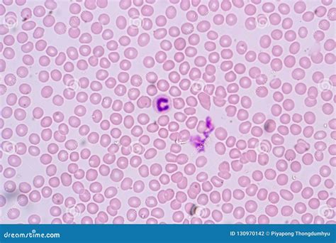 Los Glóbulos Blancos Son Las Células Del Sistema Inmune Debajo Del Microscopio En Laboratorios ...