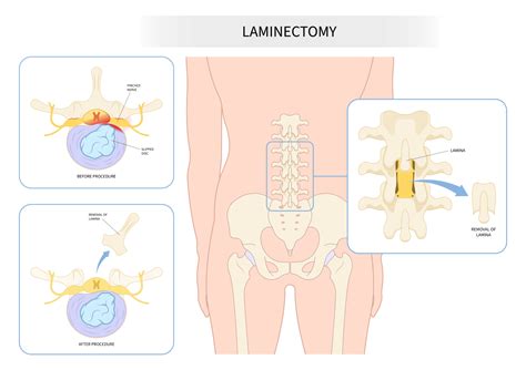 Laminectomy Surgery