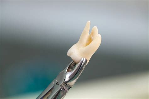 Image result for Tooth Extraction Surgery