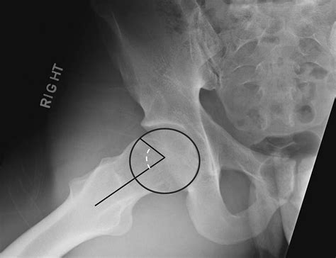Examination of acetabular labral tear: a continued diagnostic challenge | British Journal of ...