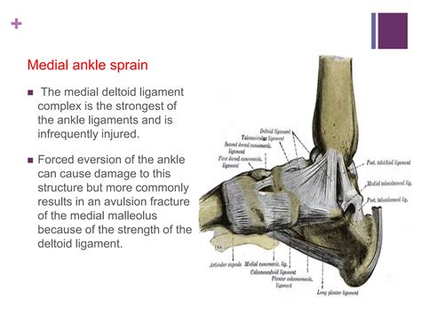 Ankle sprain | PPTX