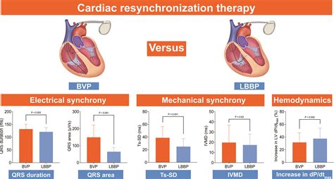 Cardiac Resynchronization Therapy Ecg
