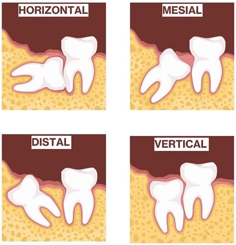 Image result for Wisdom Teeth Impaction Types