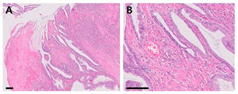 Gastric Hyperplastic Polyp Causing Upper Gastrointestinal Hemorrhage ...