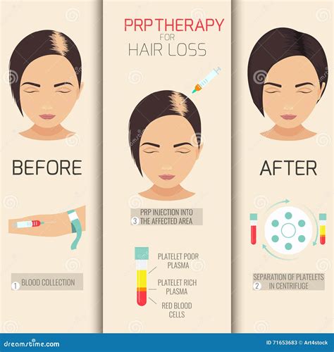 PRP therapy for hair loss stock illustration. Illustration of person - 71653683