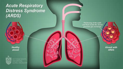 ARDS (Acute Respiratory Distress Syndrome) - St Vincent's Lung Health