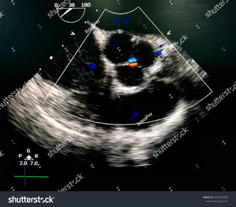 Transesophageal Echocardiogram Tee Shown Aortic Valve Stock Photo 1830578585 | Shutterstock