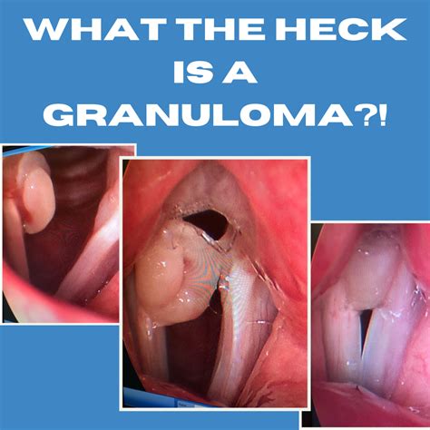 What the HECK is a Granuloma?!
