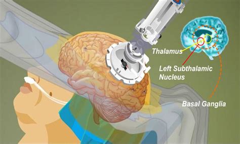 Image result for Virtual Brain Surgery Simulator