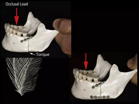 OPEN REDUCTION AND INTERNAL FIXATION OF COMBINED ANGLE AND BODY/SYMPHYSIS FRACTURES OF THE ...