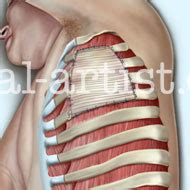 Image result for First Rib Resection Surgery