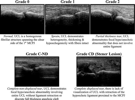 Ulnar Collateral Ligament Mri Thumb