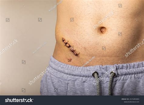 Laparoscopic Appendectomy Incision Sites