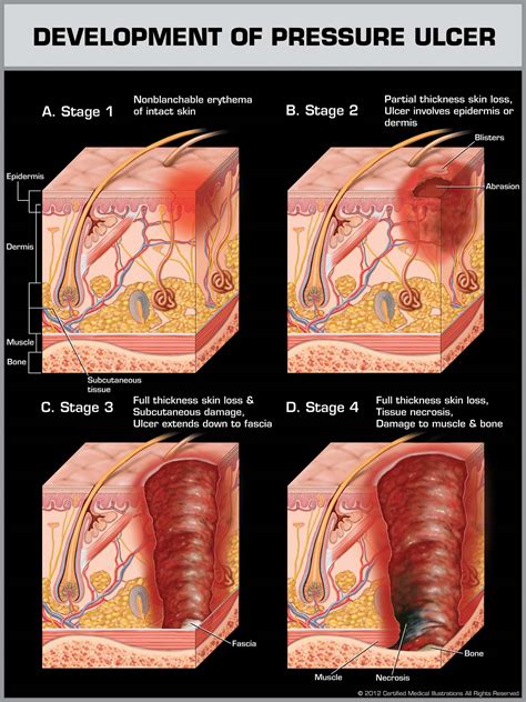 Pressure Ulcers Stage 3
