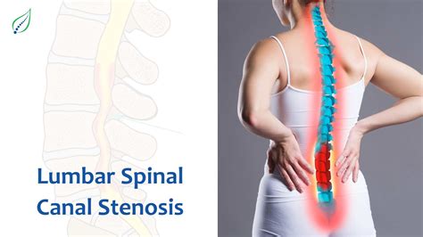 Lumbar Spinal Canal Stenosis: Causes, Symptoms, and Treatments | Blog | Best Back Pain, Slip ...