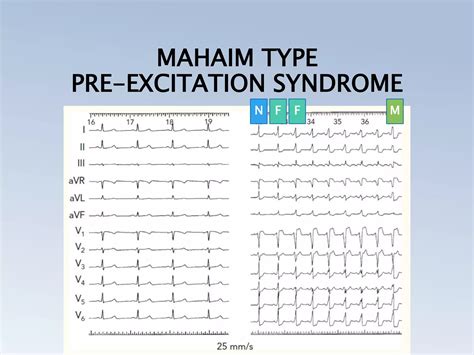 PRE EXCITATION SYNDROMES (THE WOLFF PARKINSON WHITE, LPL, MAHAIM) | PPTX