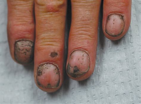 Fingernails - Ingrown fingernails - Dark Line - Fingernail Pain