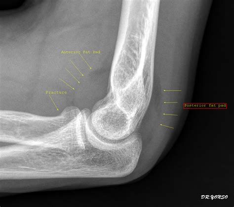X Ray Elbow Joint Effusion at Pearl Murray blog