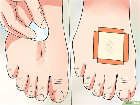 Removing Sutures Step by Step 的图像结果