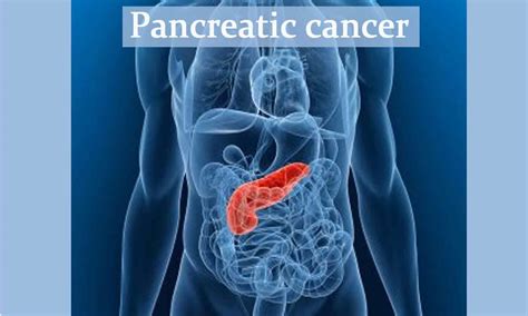 Targeted therapy may increase survival in pancreatic cancer: Lancet
