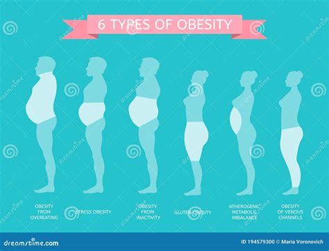 The Figure Of Man In Profile. Obesity Stages. Infographics Vector Illustration | CartoonDealer ...