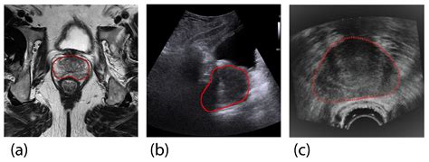 Advances in Deep Learning Methods for Prostate Segmentation and Volume ...