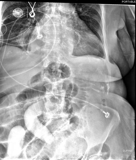 Ileus and small bowel obstruction - Cancer Therapy Advisor