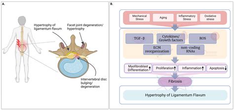 Ligamentum Flavum Hypertrophy