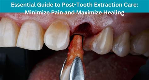 Image result for Post Tooth Extraction