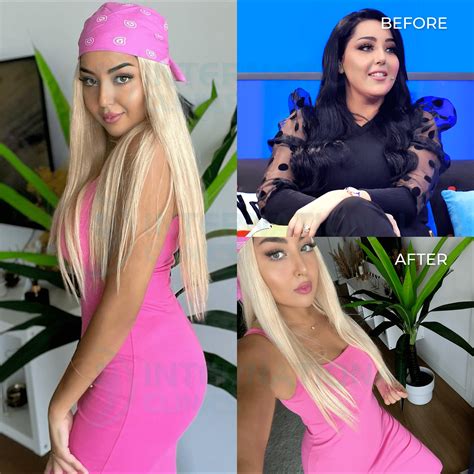 Gastric Sleeve Recovery Time: What to Expect 2025