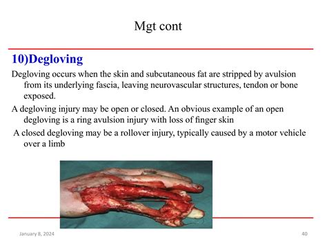 Emergency wound Mgt | PPTX